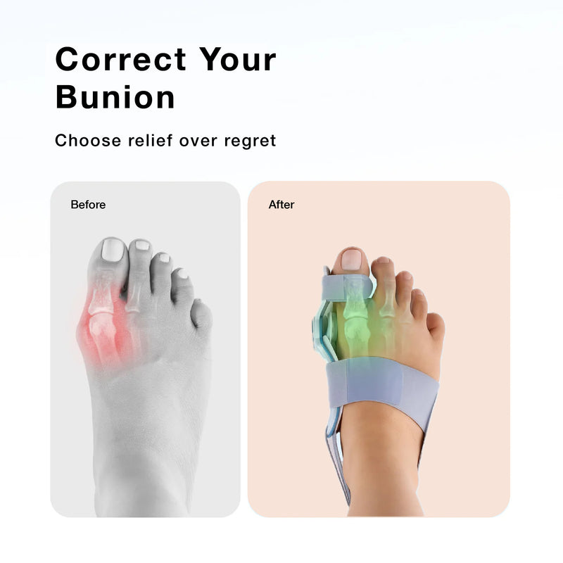 Upyogaa Bunion Corrector for Women Men | 1 year warranty