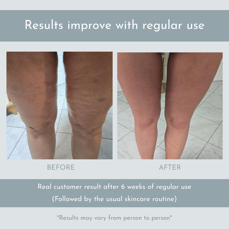 Upyogaa Cellulite Muscle Massager Roller for Men & Women | High-Density Polypropylene Skin Friendly Material |